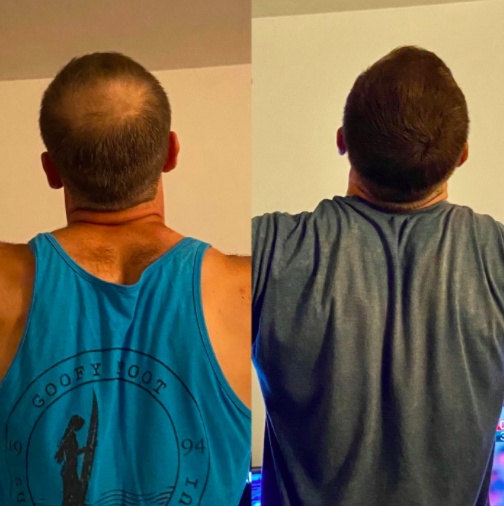 A 'before' image of a reviewer with a visible bald spot, paired with an 'after' image showing the spot seamlessly filled in by the product