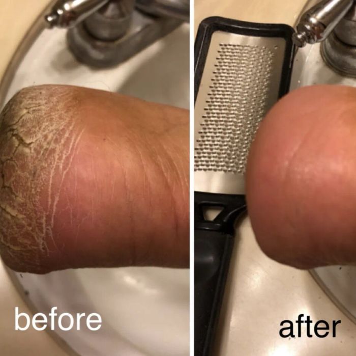 A customer's before-and-after photo showing cracked heels before and soft, smooth heels after using the file
