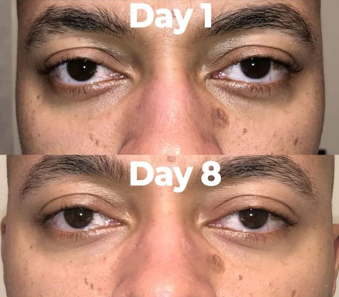 Reviewer's before and after photos showing significantly brighter undereyes after eight days of using the cream