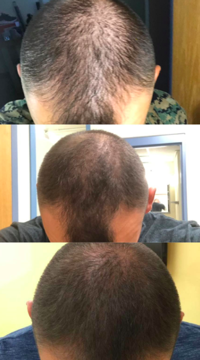A reviewer’s series of images documenting their hair growth progress after using the product