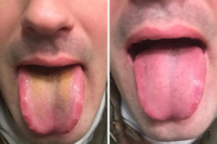 reviewer's before photo showing yellow buildup on their tongue / after photo with their tongue looking clean