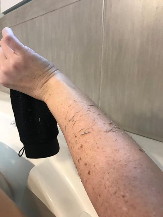 A reviewer’s arm showcasing the results after using the mitt