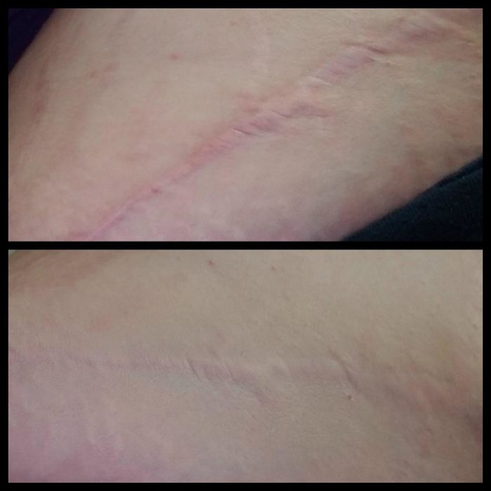A reviewer displaying before and after results of using color-correcting concealer on a scar
