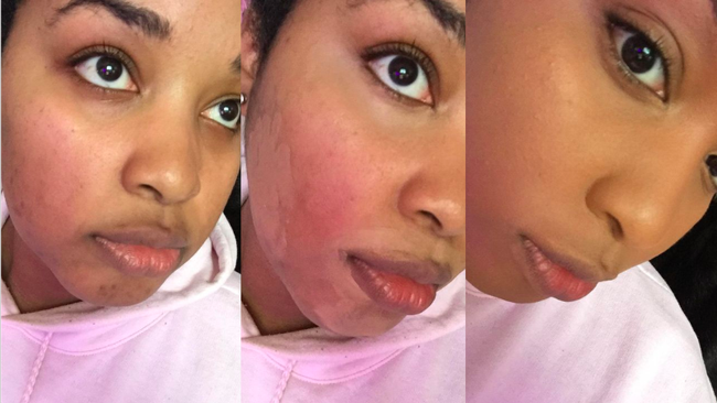 A reviewer's photo showing bright red cheek inflammation, followed by unblended concealer, and finally the concealer blended to a flawless finish