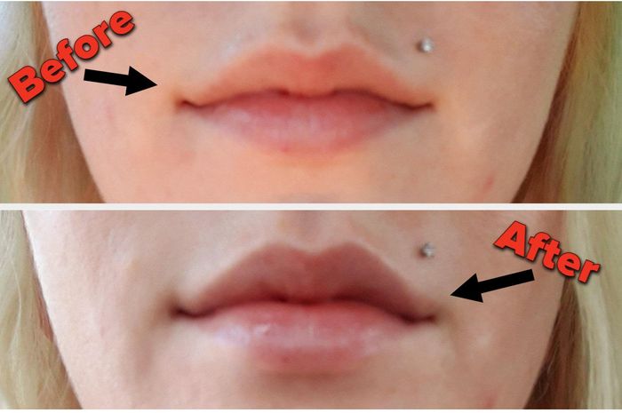 Before and after comparison of a reviewer who used the lip plumper