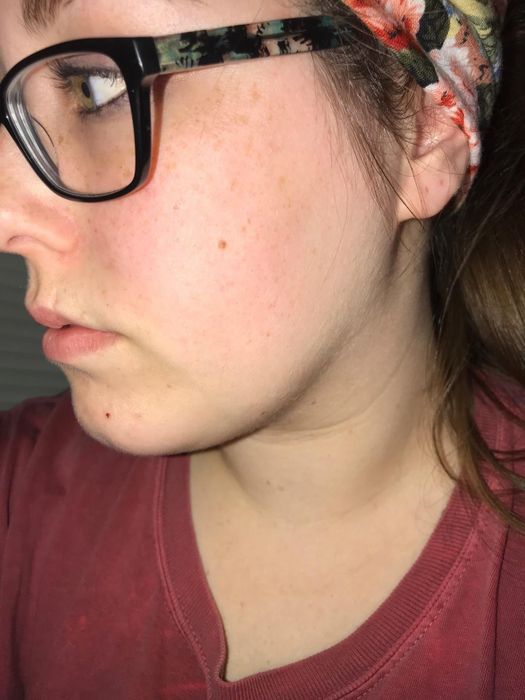 The same reviewer, now with smoother skin and less redness