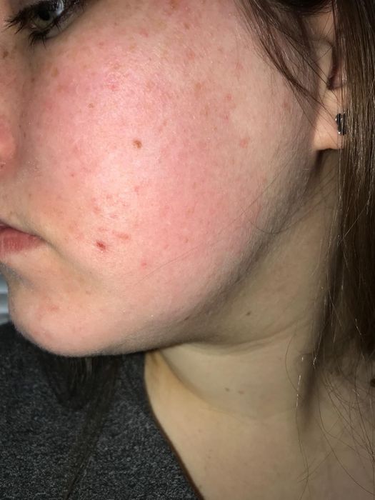 Close-up of a reviewer's cheek showing some acne and redness