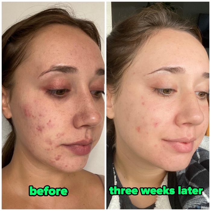 Reviewer's progress after three weeks of using Differin gel: the before photo shows widespread breakouts, while the after photo reveals significantly clearer skin with most breakouts healed