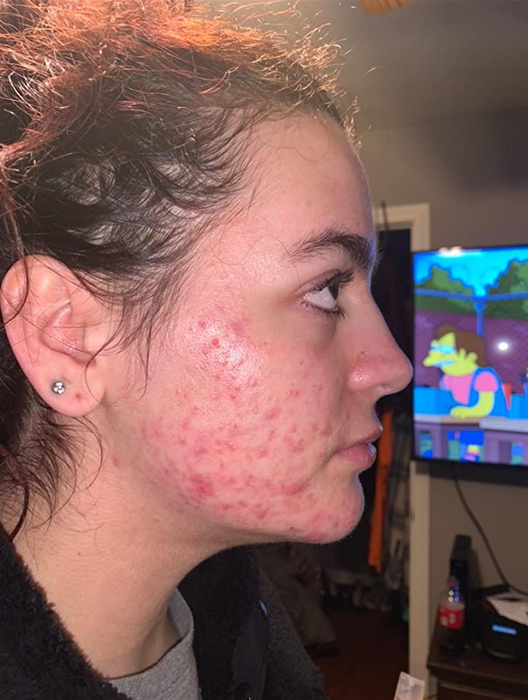 Right side of the reviewer's face covered in acne and acne scars before treatment