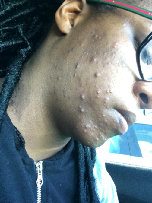 Reviewer with multiple pimples on their cheek and chin before using the wash