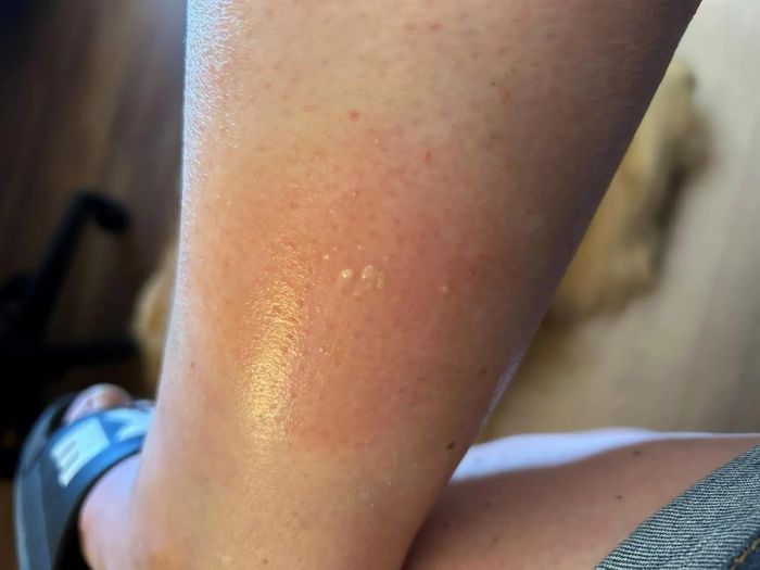 A reviewer's photo showing the salve applied to a spider bite
