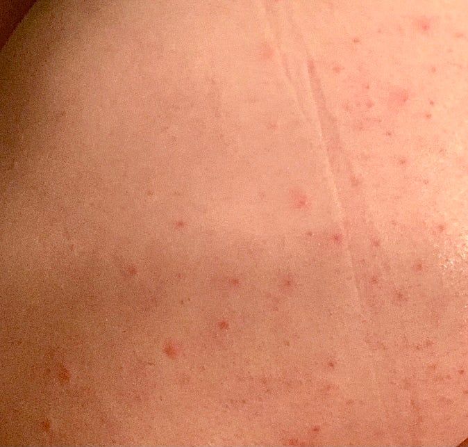 A reviewer's photo showing their skin with multiple blemishes