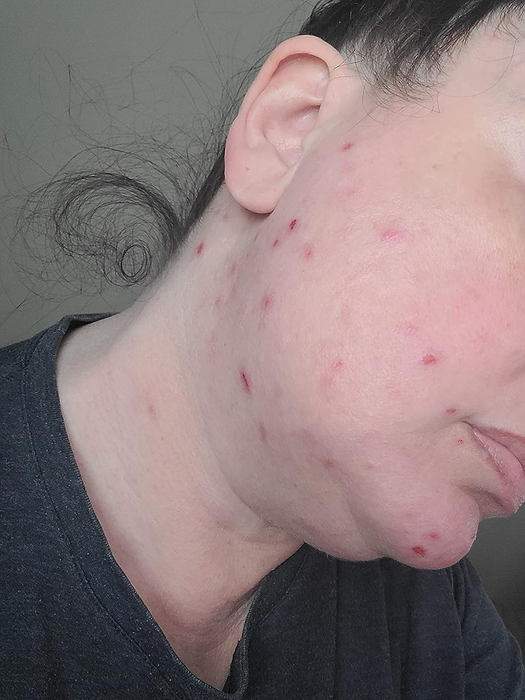 Reviewer with an acne breakout on their cheek and chin