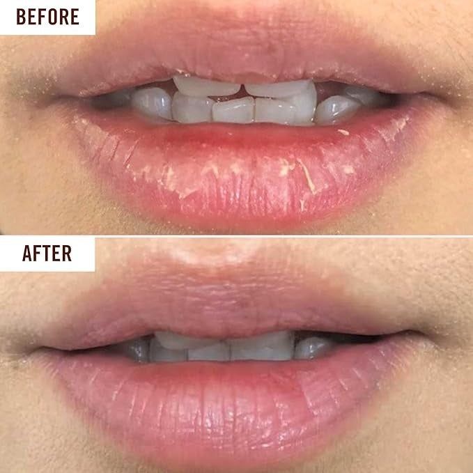 Before and after close-up shot of lips showing improved teeth alignment after using a dental product or procedure