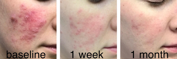 Reviewer's photo showing an inflamed rosacea patch on their cheek with raised rashes, followed by a lightly pink cheek a week later, and a nearly clear cheek after a month of use