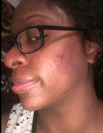 The reviewer's face looking significantly clearer after using the wash
