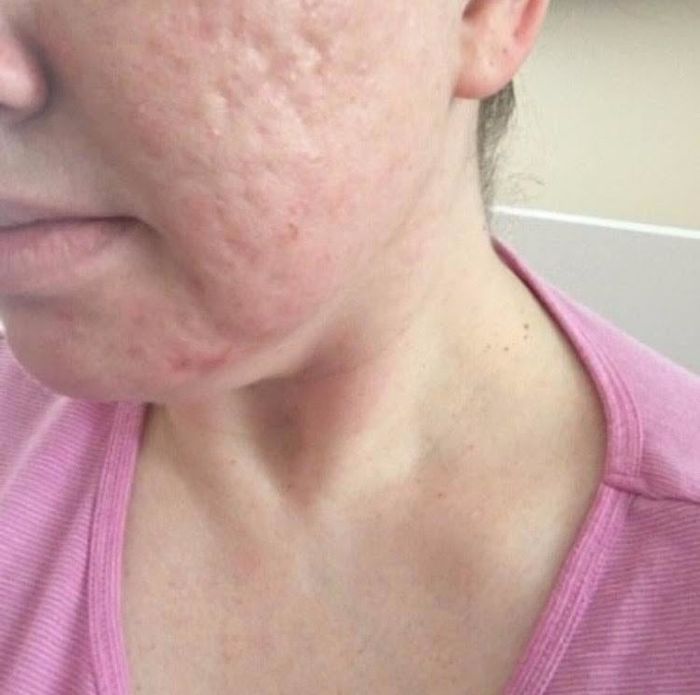 Before photo of a reviewer with uneven, dimpled skin texture on their cheeks