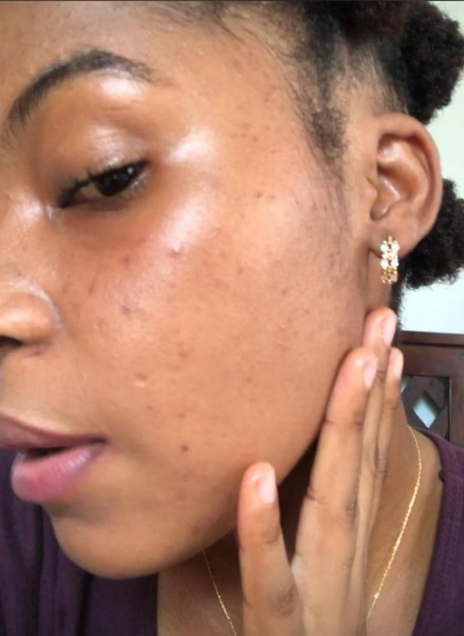 The reviewer's skin with an acne breakout before using the spot treatment