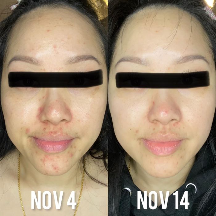 A before-and-after photo from a reviewer showing results after using the cream for 10 days.