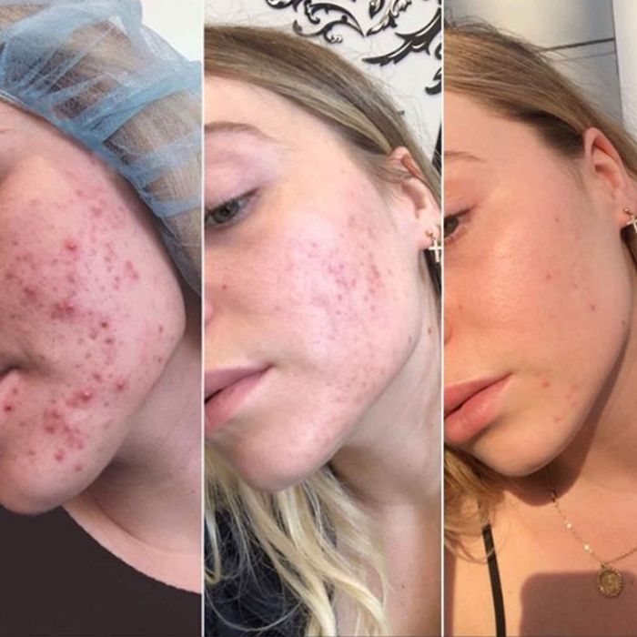 Three photos showing the progress of a reviewer's skin clearing up after an acne breakout.