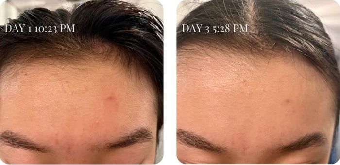 A before-and-after image showing how the face wash cleared up a breakout