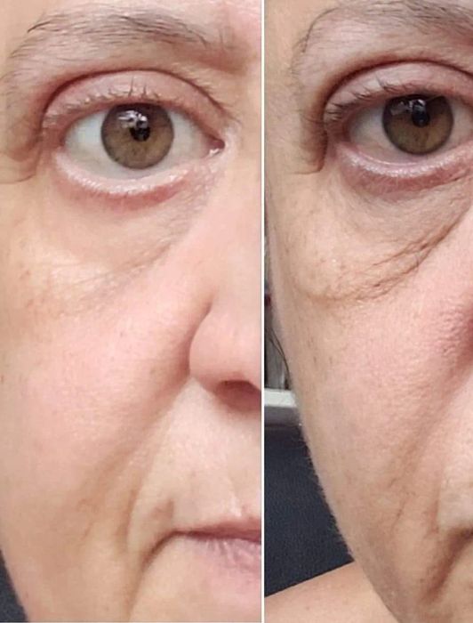 Before and after comparison showing how the cream improved the tightness and brightness of the under-eye area