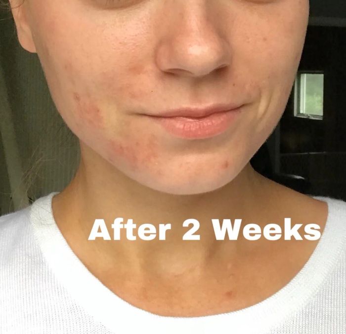 After two weeks of using the cream, the reviewer noticed a significant improvement in the clarity of their skin.