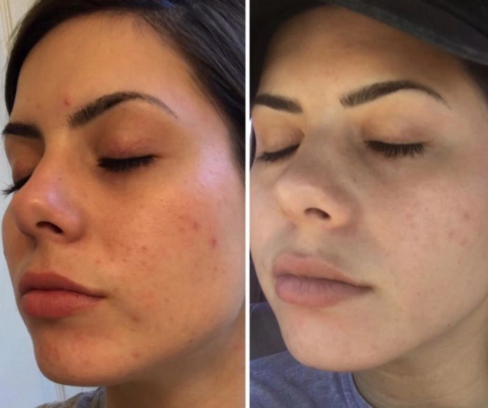 Before and after images showcasing how the serum cleared up the breakouts on the reviewer's cheek.