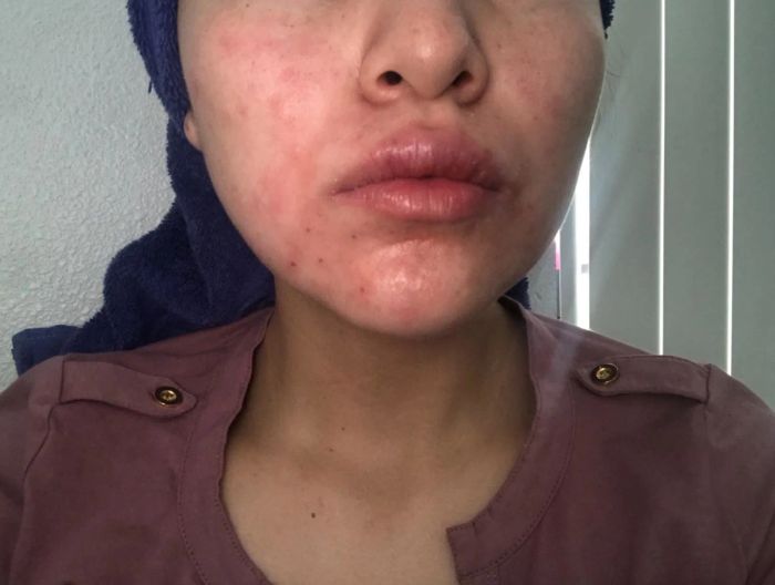 A before photo of the lower half of a reviewer’s face, showing red, blotchy, irritated skin.