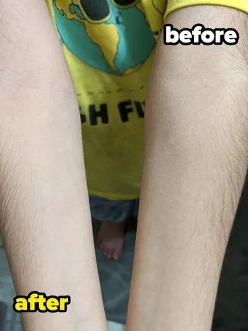 A close-up of two forearms, showing one side with smoother, more exfoliated skin.