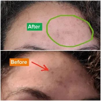 Before and after image of a forehead showing results from using the face wash.
