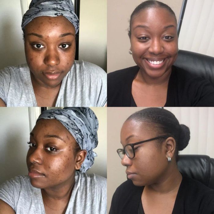 A reviewer with dark skin shows how the serum dramatically faded the acne scars on their forehead and cheeks, leaving their skin almost clear.