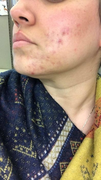 The same reviewer showing reduced and healed acne.