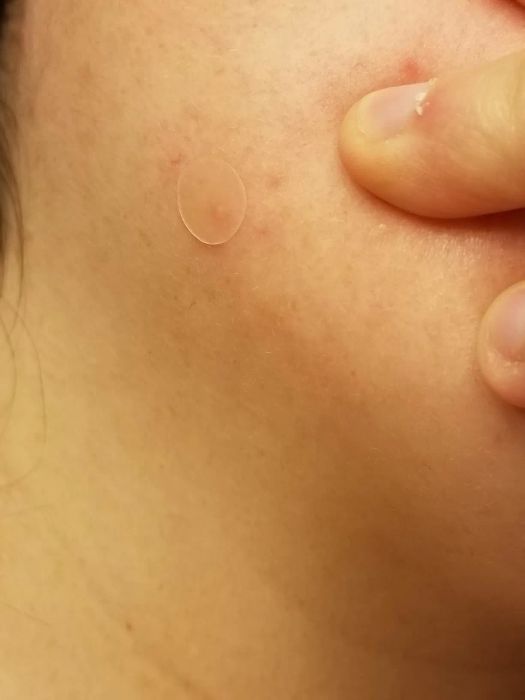 A pimple patch applied to a reviewer's cheek.