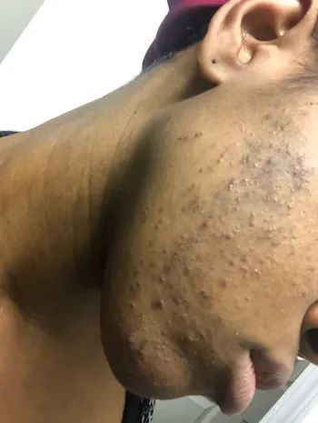 A reviewer photo showing their skin with acne.