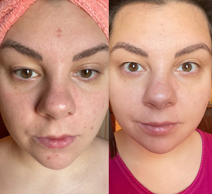 A reviewer's face showing acne spots on the forehead and chin (left) and the same reviewer's face (right) with fewer acne spots after using the serum for a week.