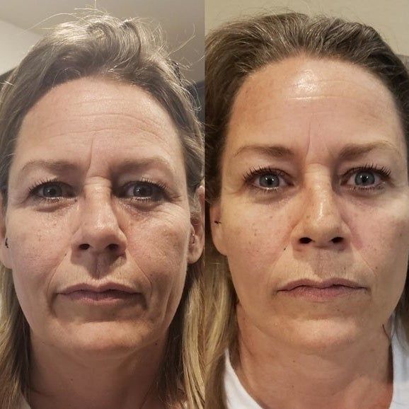 Reviewer before and after using the mask, showing tighter skin and diminished wrinkles