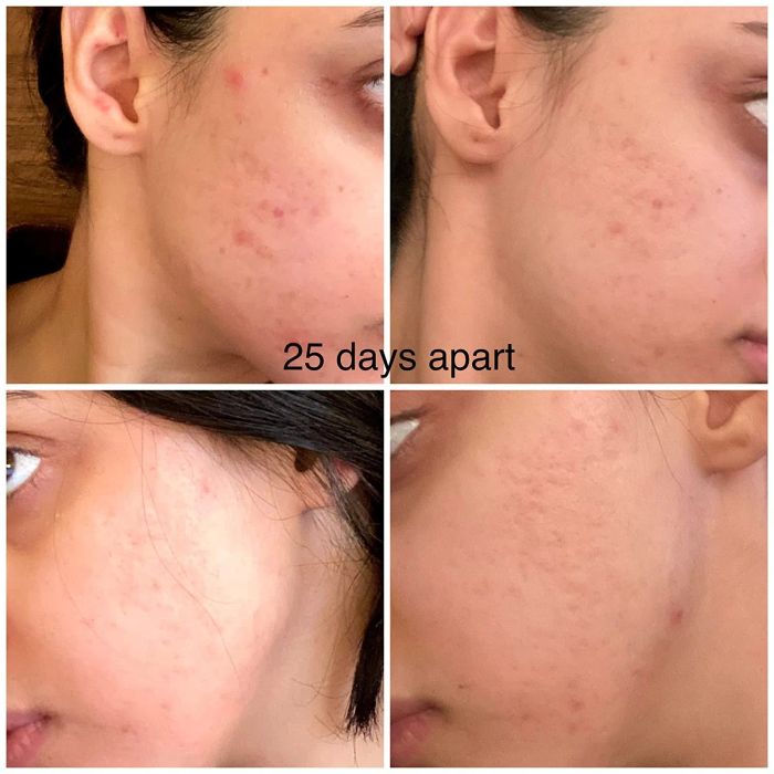 A before-and-after photo comparison showing a reviewer's cheek with red, active breakouts initially, and then, 25 days later, the same cheek appears clear, even-toned, and completely free of breakouts.