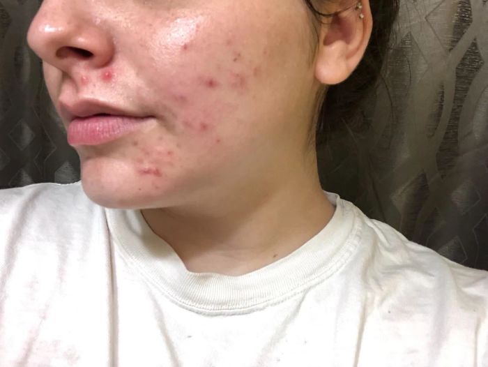 A before photo of a reviewer with red, inflamed breakouts along their cheek and jawline.