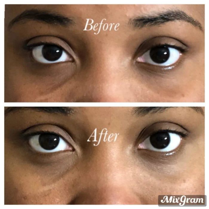 Before-and-after photos showing how the eye masks helped reduce dark circles under a user’s eyes.