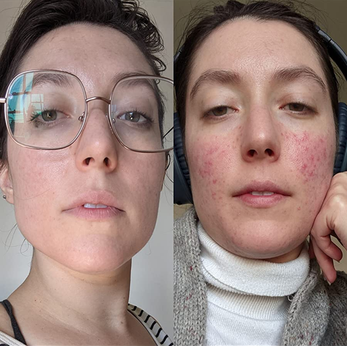 A reviewer's before-and-after photos, with the right showing their skin covered in acne, and the left showing a much clearer complexion after using the cleanser.