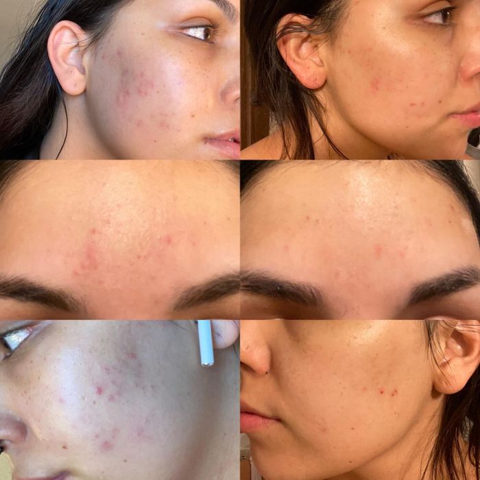 Three before-and-after photos showing a reviewer's blemishes fading after using the toner