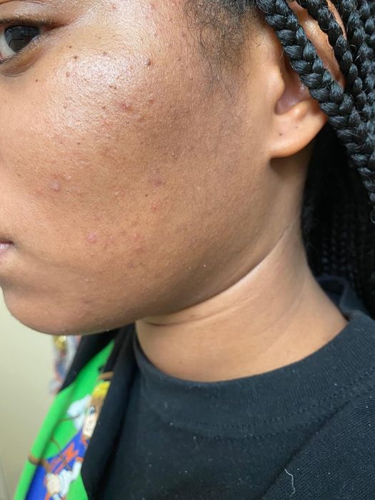 A reviewer's skin after using the exfoliant, now clear and smooth.