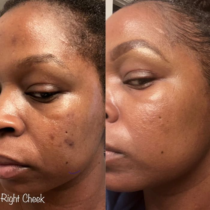 A before-and-after comparison showing a reviewer with acne and how their skin cleared up over time.