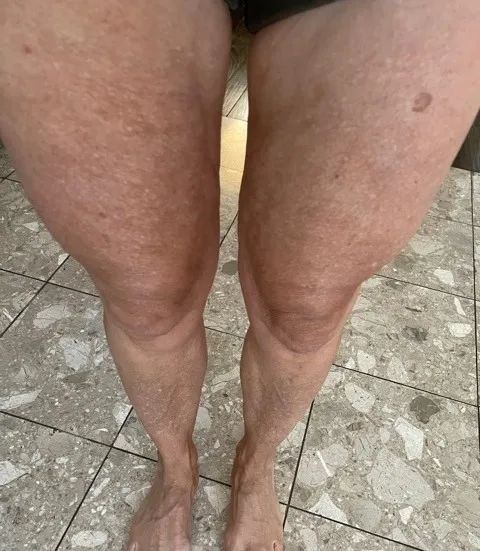 An after photo of the same reviewer, with noticeably firmer skin and much-reduced cellulite on their legs.