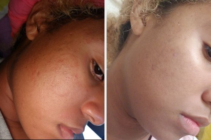Before-and-after photos from a reviewer showing reduced acne inflammation in the second image