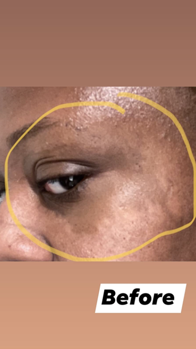 Before photo of a reviewer showing facial discoloration