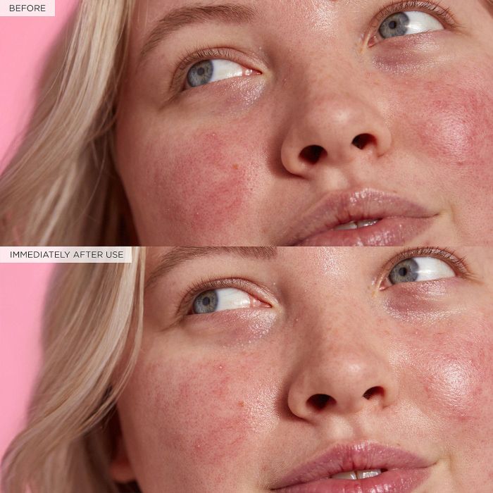 Immediate before and after photos showing a person’s redness significantly reduced after using the serum