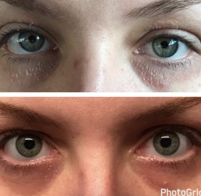 individual with severely dry and cracked under-eye area now appearing refreshed and moisturized