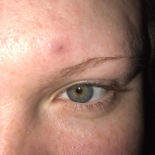 The same pimple now flattened and appearing to heal